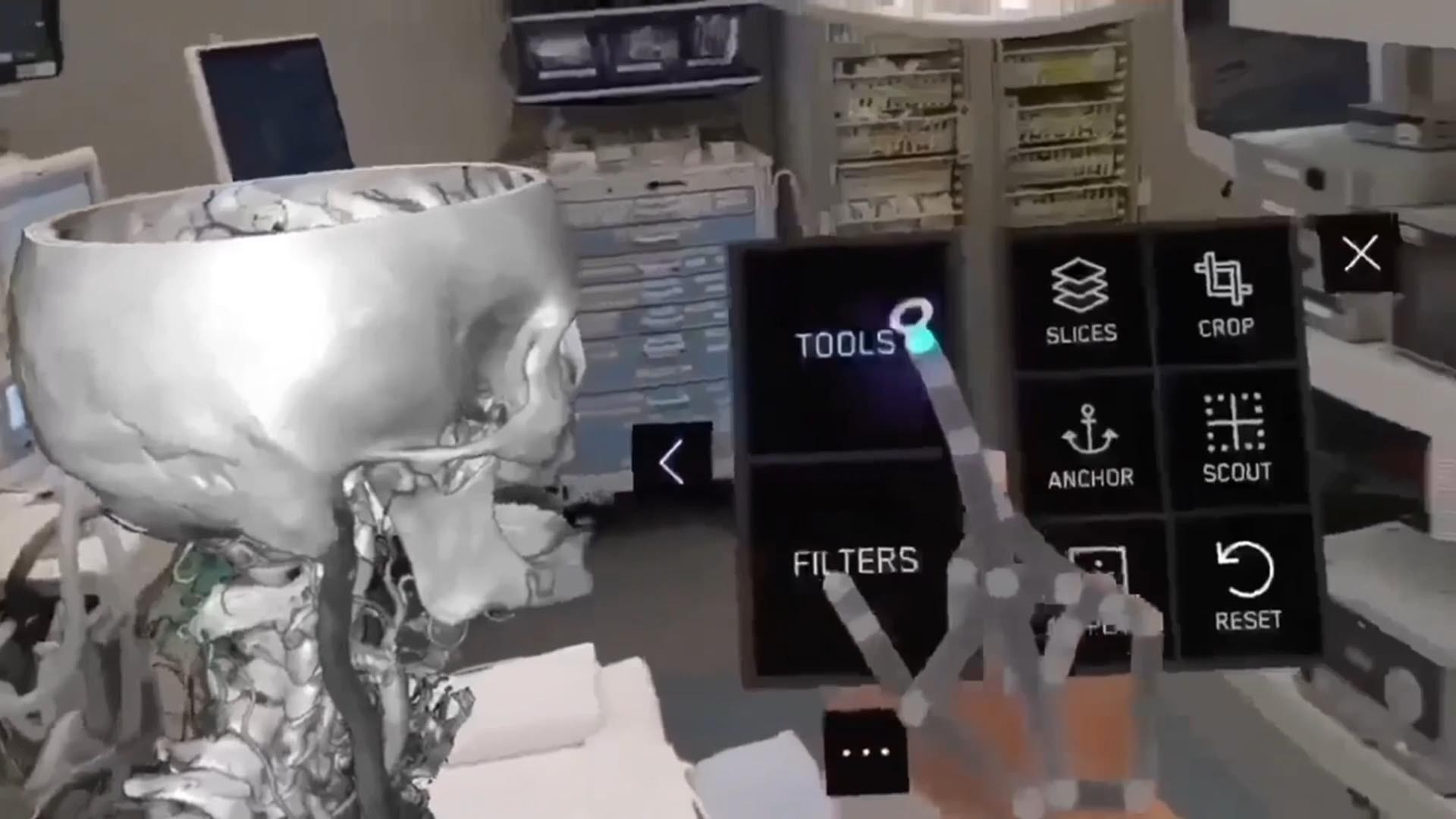 XR-Overlay in der Kopf-OP mit Apple Vision Pro