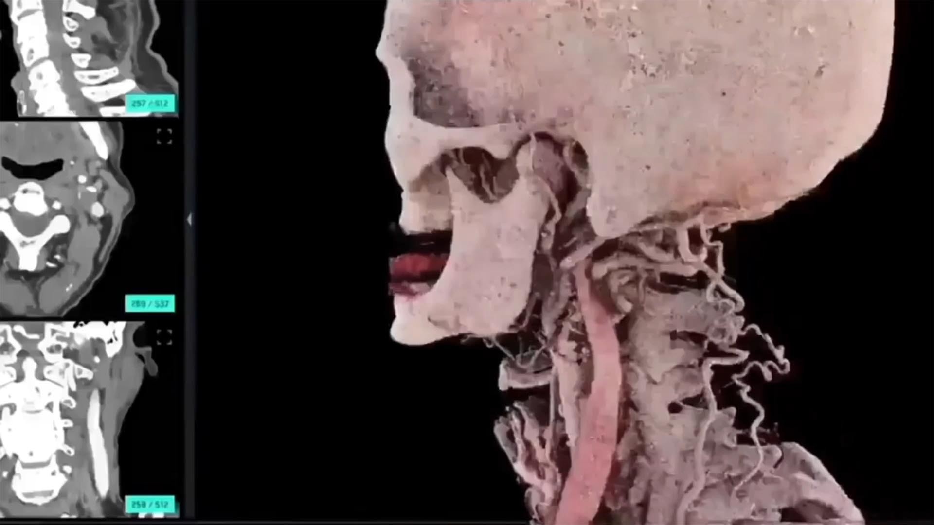 3D-Visualisierung von Anatomie mit Vision Pro